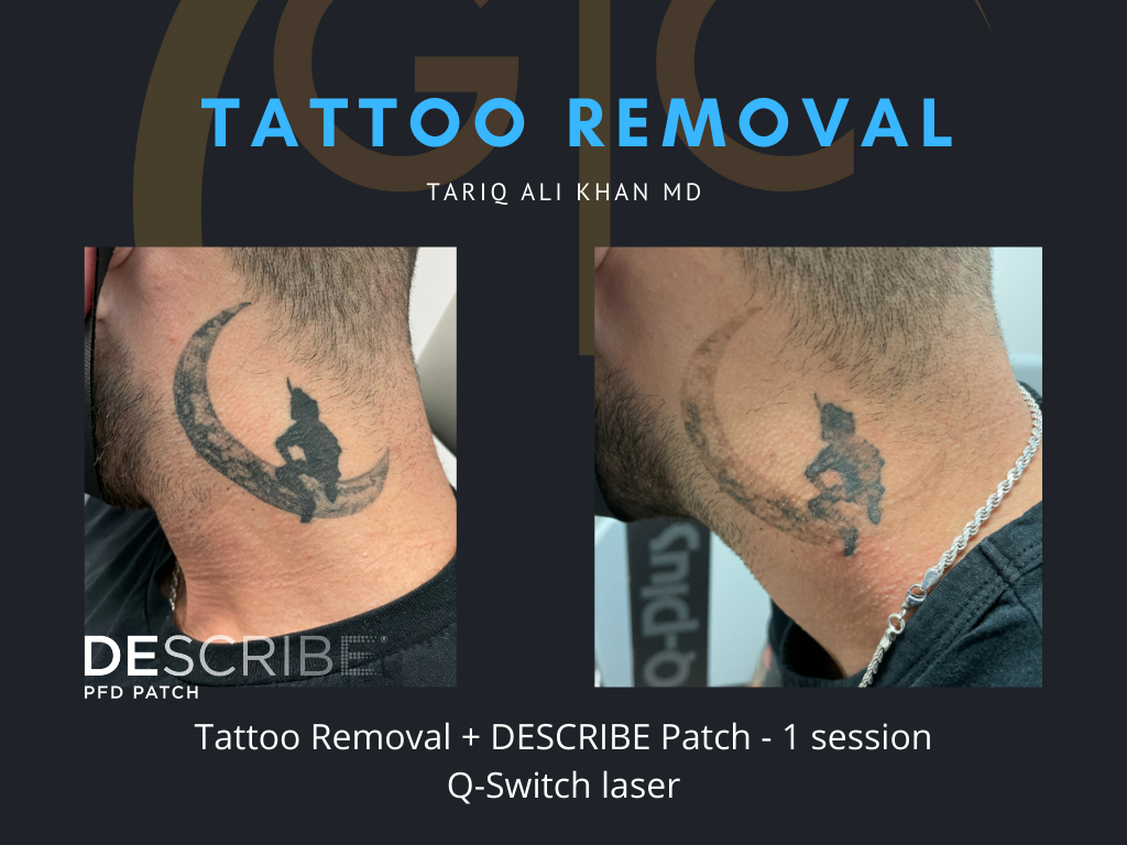 Gentle Care Laser Tustin Before and After picture - Tattoo Removal Mucosal Surface